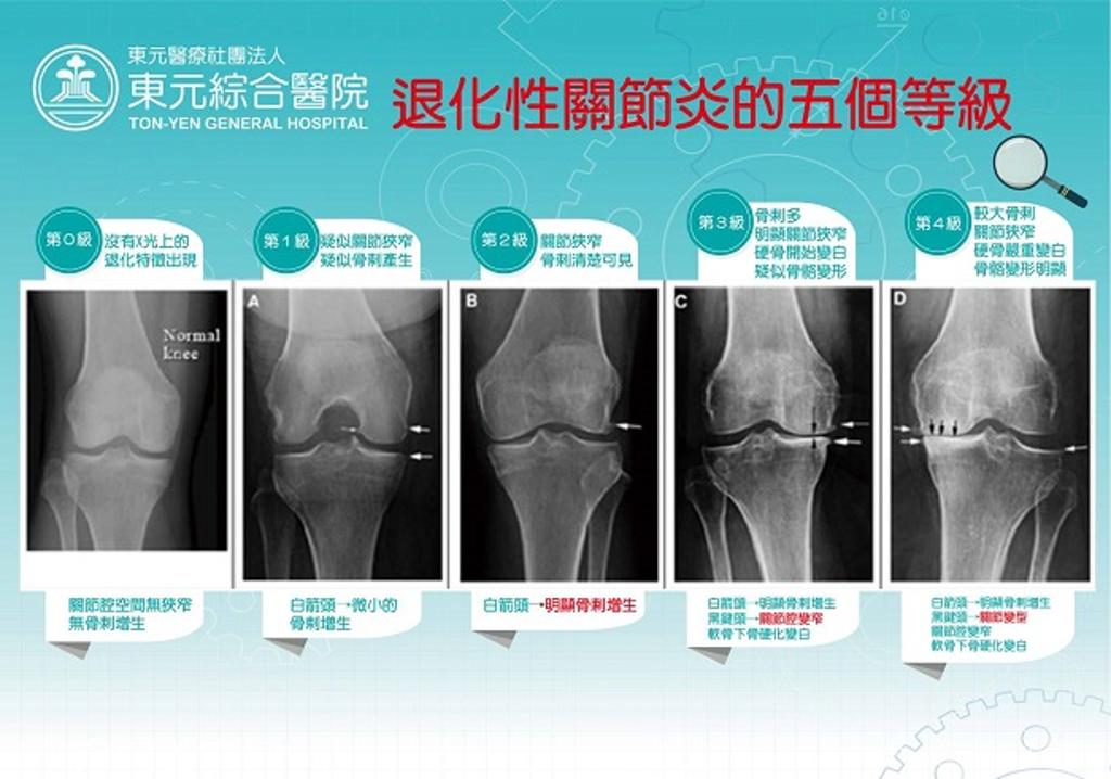 Kellgren-Lawrence X-ray膝關節退化性五等級分類法。圖／東元綜合醫院