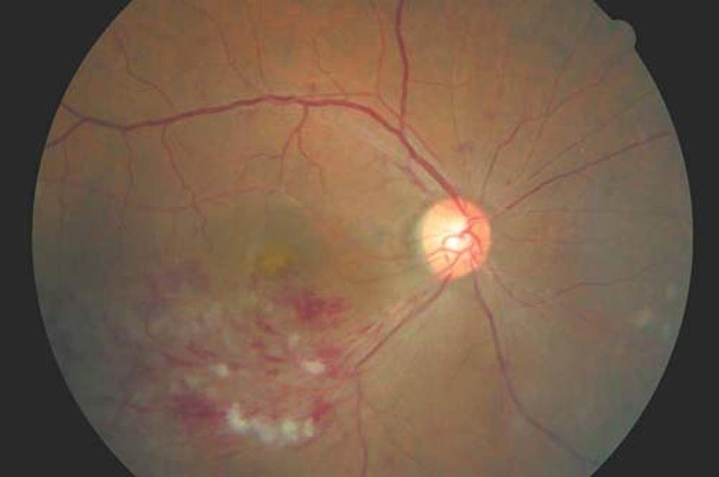 眼中風眼底照相：可見視網膜水腫、出血及缺血，視力僅0.05。圖／新光醫院提供 