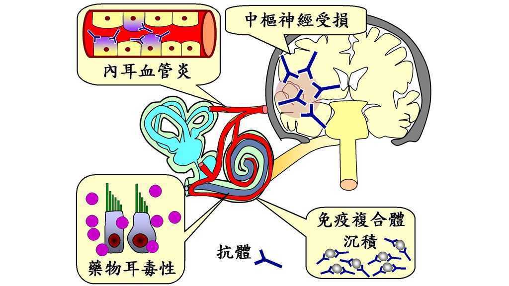 台醫新發現登國際期刊 紅斑性狼瘡可能啟動聽力退化